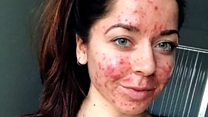 'Acne doesn't define you'