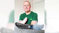 'One tiny wound cost me my whole hand'