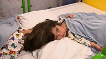 How doctors separate twins joined at the head