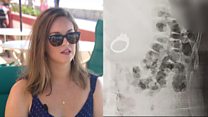 Woman describes swallowing her engagement ring