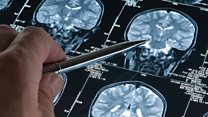 Drug 'could be biggest thing to happen in Alzheimer's'