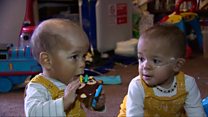 The cuddle which 'saved' a premature baby