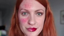 Model 'felt sick' as Instagram axed rosacea images