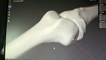 Apps help orthopaedic patients prepare for surgery