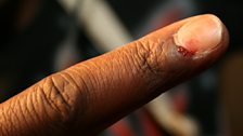 Guitarist Andew's bleeding finger