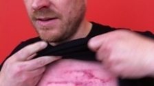 Richard Cadey's Wrestling Bruise