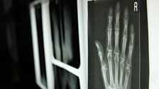 Hand x-rays in the dissected lab