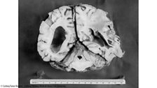 Brain Surgery's Earliest Patients