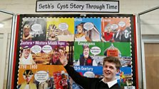 Seth's cyst story