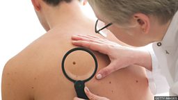 Skin cancer: Half of people surviving advanced melanoma 皮肤癌：黑色素瘤晚期存活率过半