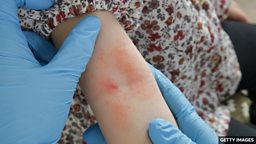 Baby sticky tape skin test can predict eczema risk 用胶带做皮肤测试有助预测婴儿湿疹