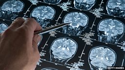 Alzheimer's drug breakthrough 阿尔茨海默病治疗药物获重大突破