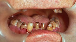 Scurvy affecting gums of the human mouth