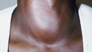 Thyroid goitre on the neck of a woman