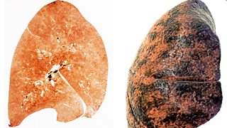 pictures of damaged lungs caused by smoking