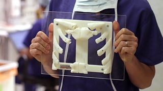 NHS surgeons use high-tech 3D printers to create replacement ribs