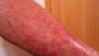 How Does Smoking Affect Psoriasis?