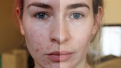 A 'before and after' photo of Katie Snooks showing her acne