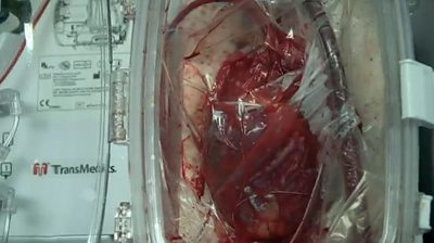 Heart beating in transplant machine
