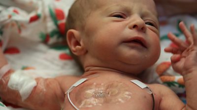 A premature baby with wired monitors and a patch on her chest