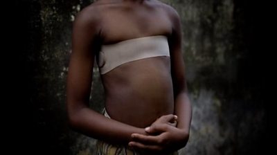 A girl with strap around her chest following breast ironing