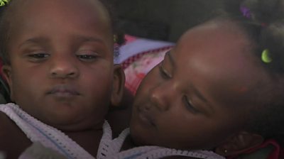 Conjoined twins Marieme and Ndeye continue to surprise doctors