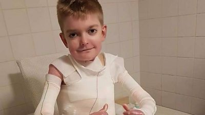 Rhys has epidermolysis bullosa, a painful, life-limiting condition that has left him unable to walk.