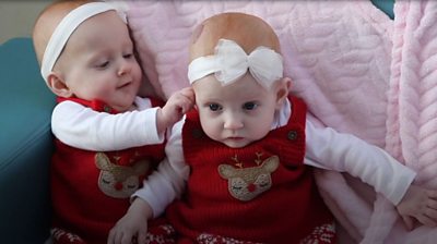 Sisters April and Evie were born with a rare defect which affects one in 4000 newborns.