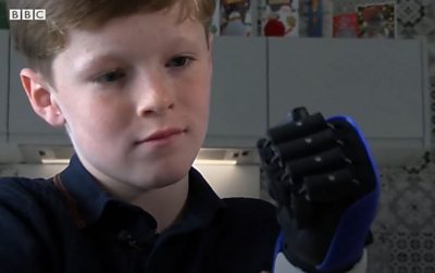 Jacob Pickering with his bionic arm