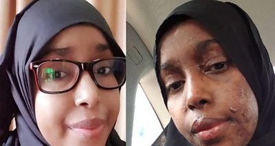 Two images of Zeinab, before and after the attack