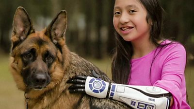 11-year-old girl gets Star Wars bionic arm