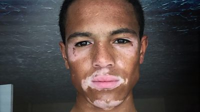 Nile Goodlad was bullied because of his skin condition, now he's an international fashion model.
