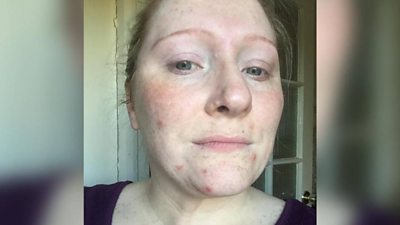 Angharad Lewis did not want to leave home because of her polycystic ovary syndrome symptoms