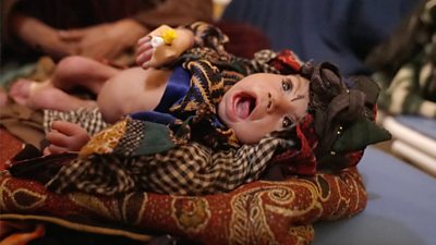 A malnourished baby crying on the hospital bed