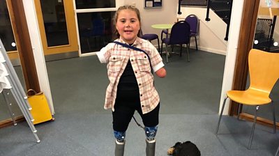 Harmonie standing on her prosthetic legs