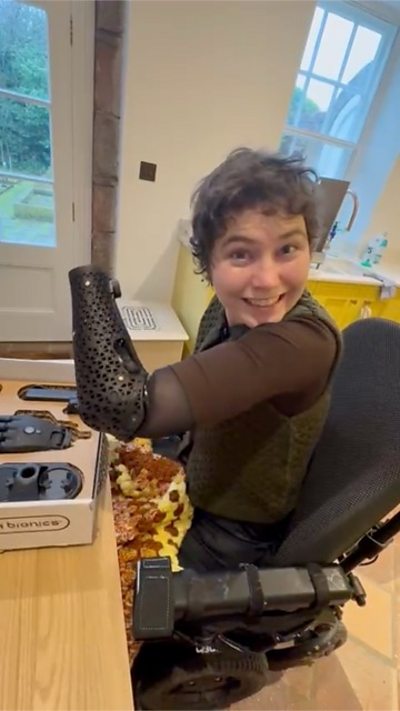 An amputee displays her new bionic arm whilst smiling at the camera