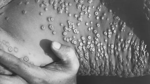 Witness History, Witness History, The last smallpox outbreak