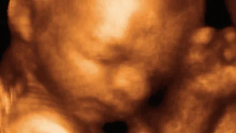Witness History, Witness History, The First Foetal Surgery