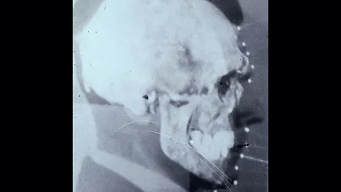 Witness History, Witness History, How science ended the search for Josef Mengele