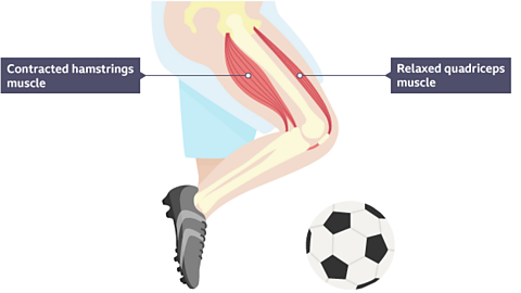 knee with contracted hamstrings and relaxed quadriceps