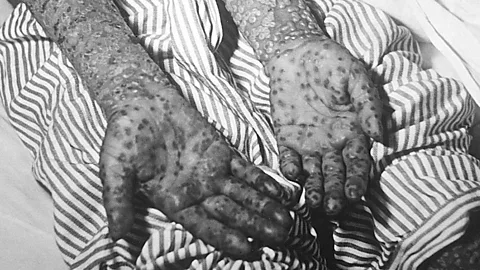 Witness History, Witness History, Europe's last smallpox epidemic