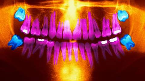 CrowdScience, CrowdScience, Why do we have wisdom teeth?