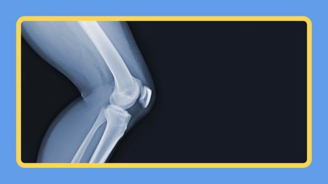 An X-ray of a knee joint and leg.