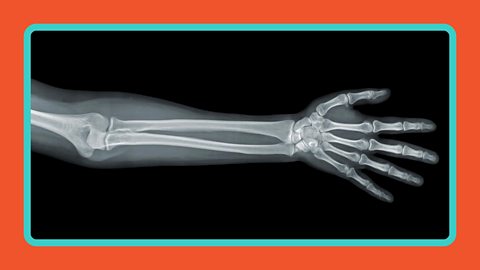 An x-ray of an arm.