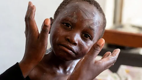 The Documentary Podcast, BBC OS Conversations: What's it like to have mpox