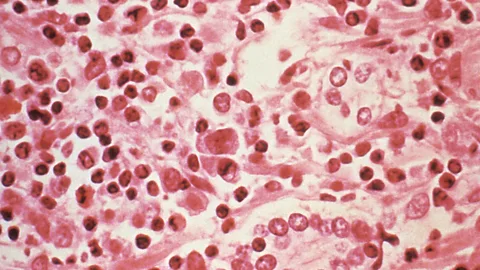 Global News Podcast, WHO: Hantavirus may have spread between humans