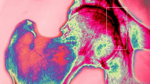 A coloured x-ray of a right hip joint shaded red where chronic arthritis has damaged the bone (Credit: Getty Images)
