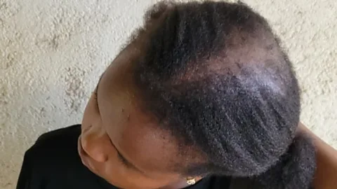 Focus on Africa, Focus on Africa, "I'm 23 and losing my hair"
