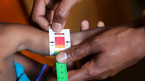Focus on Africa, Somalia: Humanitarian agency warns malnutrition