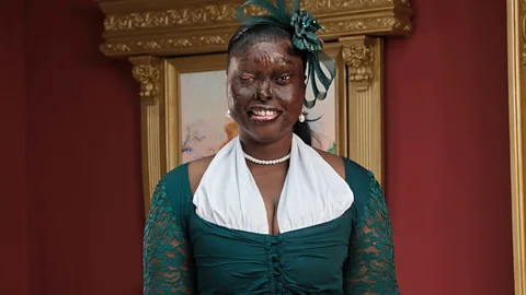 Focus on Africa, Surviving an acid attack